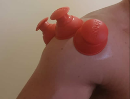 Cupping Therapy