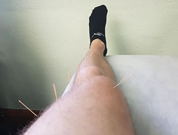 Medical Acupuncture